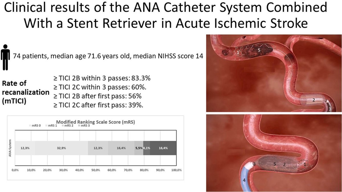 Stroke AHA/ASA (@strokeaha_asa) on Twitter photo ANA system—self-expanding funnel designed to reduce clot fragmentation—combined w/stent retriever shows high rate of complete recanalization, good safety profile & favorable 90d outcomes ahajrnls.org/3S6nMcL <a href="/dliebesk/">David S Liebeskind, MD, MBA</a> <a href="/Sremollo/">Sebastià Remollo</a> <a href="/neuroplumber/">Manu Moreu , MD, PhD</a> <a href="/sanchezsonia123/">Sonia Sanchez</a> @ManuRequenaRuiz ANA system—self-expanding funnel designed to reduce clot fragmentation—combined w/stent retriever shows high rate of complete recanalization, good safety profile & favorable 90d outcomes ahajrnls.org/3S6nMcL <a href="/dliebesk/">David S Liebeskind, MD, MBA</a> <a href="/Sremollo/">Sebastià Remollo</a> <a href="/neuroplumber/">Manu Moreu , MD, PhD</a> <a href="/sanchezsonia123/">Sonia Sanchez</a> @ManuRequenaRuiz