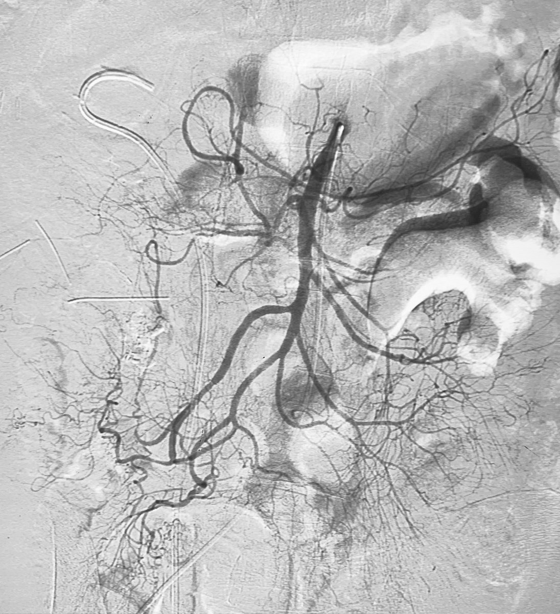 Dr Ajit Yadav (@drajityadav) on Twitter photo Another Bleeder from SMA branches
GLUE embolization done
Liquid embolic material is best in small artery active bleed 🩸
# Distal penetration depend on percentage of Glue
<a href="/ELEC_radiology/">European Liquid Embolic Course</a> <a href="/RajNarayanan67/">Raj Narayanan</a> @IR_juniors <a href="/ISVIRIndia/">ISVIR India</a> <a href="/paragpatel_IR/">Parag Patel</a> <a href="/drgauravgangwni/">Dr. Gaurav Gangwani (Interventional Radiologist)</a> <a href="/SIRRFS/">SIR RFS</a> Another Bleeder from SMA branches
GLUE embolization done
Liquid embolic material is best in small artery active bleed 🩸
# Distal penetration depend on percentage of Glue
<a href="/ELEC_radiology/">European Liquid Embolic Course</a> <a href="/RajNarayanan67/">Raj Narayanan</a> @IR_juniors <a href="/ISVIRIndia/">ISVIR India</a> <a href="/paragpatel_IR/">Parag Patel</a> <a href="/drgauravgangwni/">Dr. Gaurav Gangwani (Interventional Radiologist)</a> <a href="/SIRRFS/">SIR RFS</a>