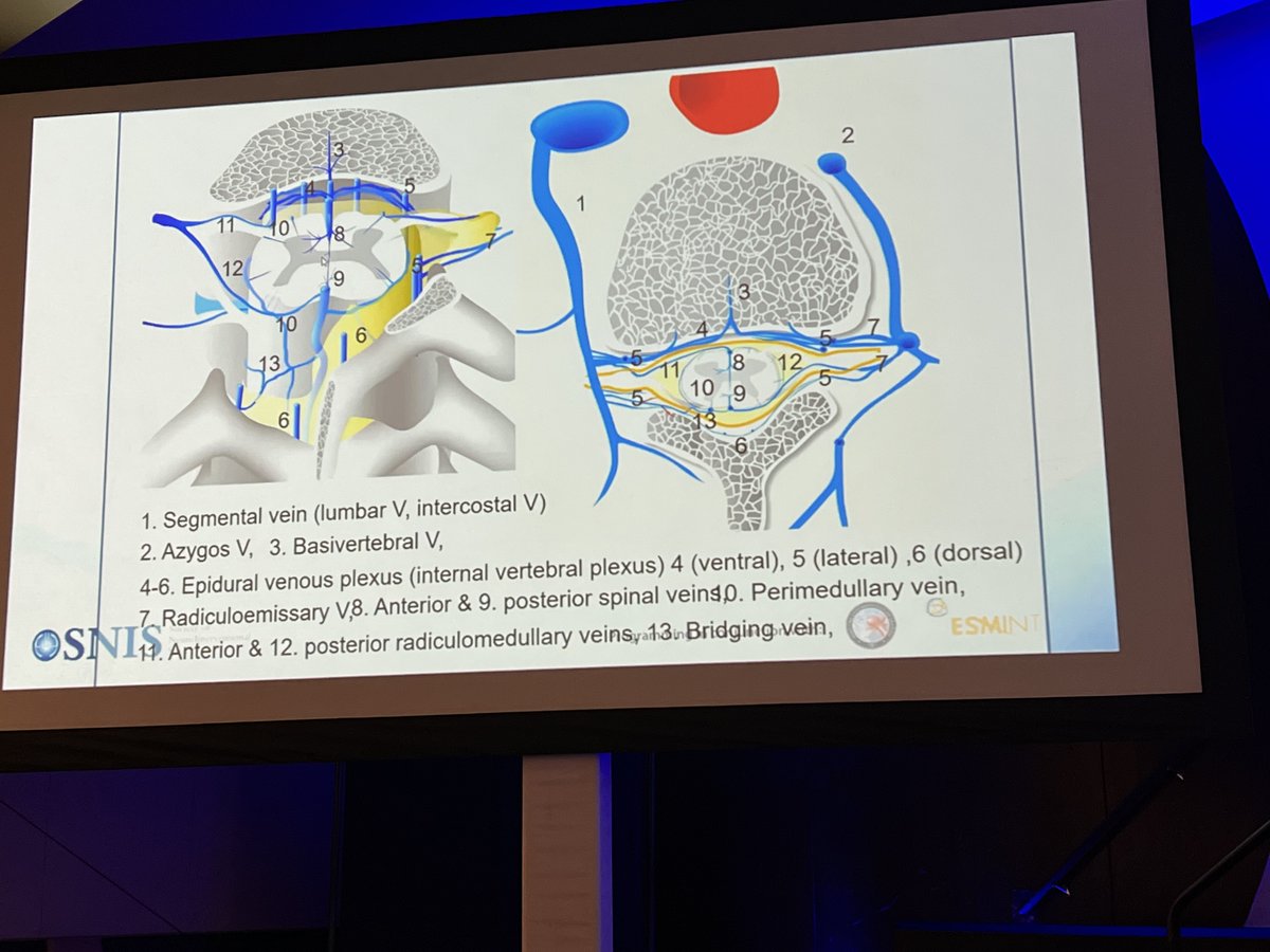 JNIS (@jnis_bmj) on Twitter photo Day 3 #SNIS2022 starts with #Neuroanatomy Master Class: Dr. Hiro Kiyosue reviewing critical spinal cord neurovasculature
#SNIS2022 #NeuroTwitter
<a href="/SNISinfo/">SNIS Info</a> <a href="/esmintsociety/">ESMINT Society</a> <a href="/cvsection/">CV Section</a> Day 3 #SNIS2022 starts with #Neuroanatomy Master Class: Dr. Hiro Kiyosue reviewing critical spinal cord neurovasculature
#SNIS2022 #NeuroTwitter
<a href="/SNISinfo/">SNIS Info</a> <a href="/esmintsociety/">ESMINT Society</a> <a href="/cvsection/">CV Section</a>