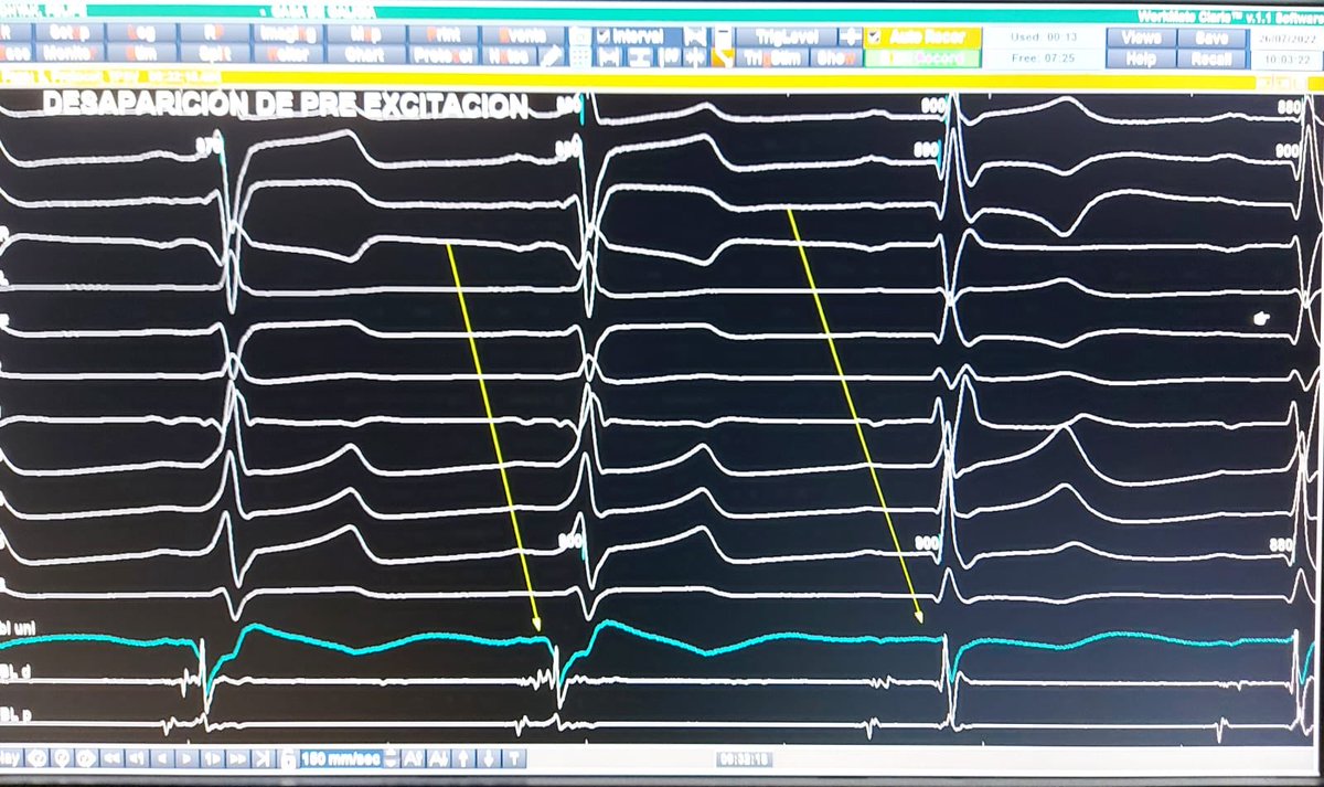 drgonzalovarela's tweet photo. 12 años. Enfermedad de Ebstein. WPW. Ablacion de 2 vias accesorias. Sin Rayos X. Servicio de Arritmias Circulo Catolico #ZeroFluoroLessRisk @gtortabel @mcirculoc @zcortellezzi @miguelalvarlop @reyescaorsi https://t.co/E8wZ7M5TEa