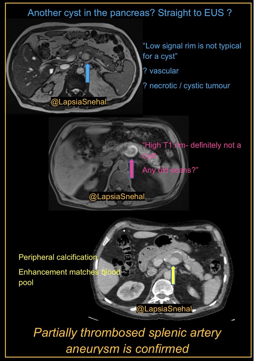 LapsiaSnehal's tweet image. Knowing your sequences is key!! #FOAMrad #FOAMed #meded  #radres #futureradres #medstudenttwitter #gitwitter #anatomy #frcr #surgery #radiology #radtwitter #medtwitter #hpb #mri #vascular #gastro #irad
