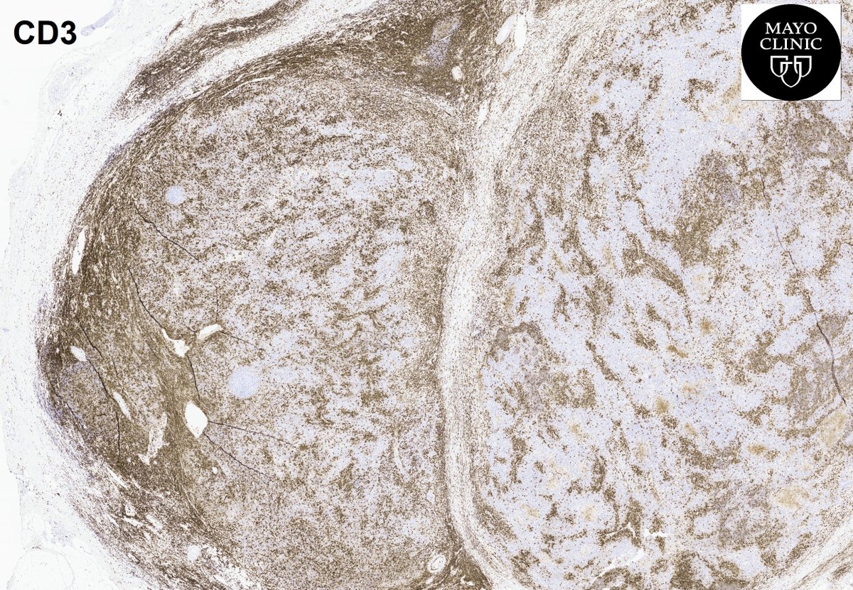 MayoPathology's tweet photo. IHC for #hematopath workup https://t.co/dbM9weVmhb