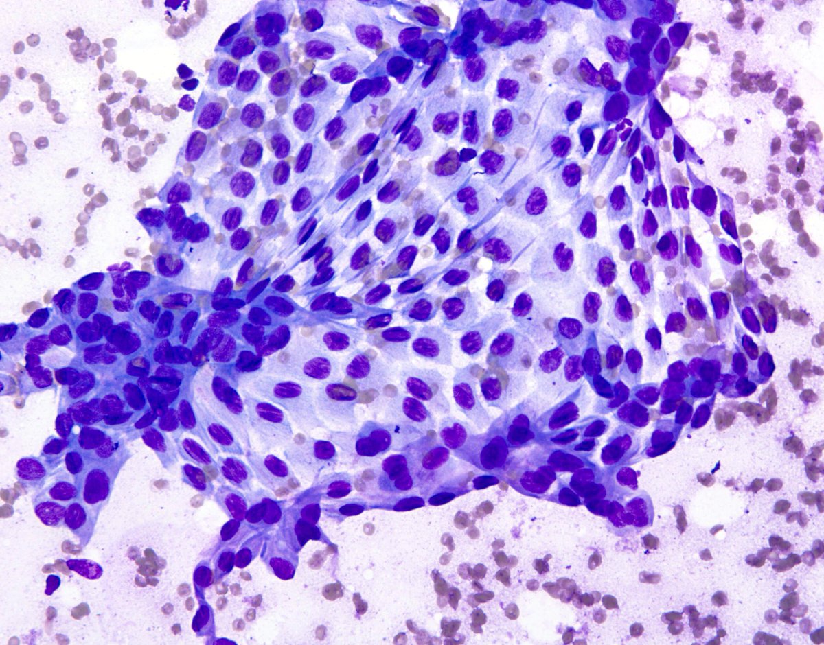 "YES", benign mesothelial cells can have "intranuclear inclusions" (INCIs) and nuclear grooves. (Contaminating mesothelium in a transabdominal FNA from a case of sclerosing mesenteritis).