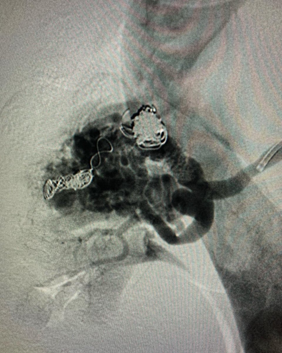 lbncbma's tweet photo. PostOp MAV/high flow #endovascularsurgery #PTA #criticallimbIschemia #thinkaorta  #medtwitter
#aneurysm #endolaser #vasculartraining #hybridroom #teamvascular #revascularization  #surgicalbypass #varizes #ivus #peripheralarterialdisease #PADdiagnosis #intravascularultrasoud https://t.co/f4Rz0PU4oW