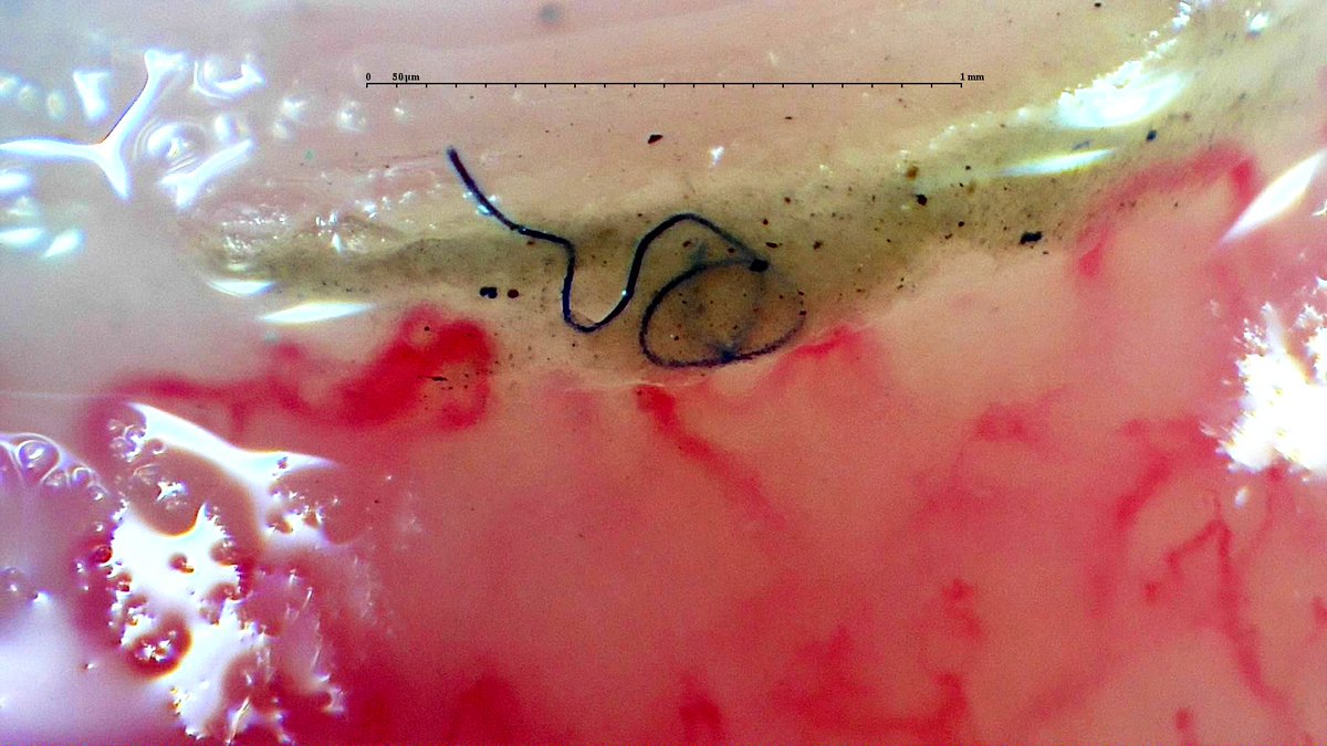 gmaldonadovelez's tweet photo. Capillaroscopy of the day in Raynaudโs initial assessment ๐ฌ
๐ชก Foreign object, likely a threat
โ Reduced density
๐ Architecture rearrangement
๐ณ Tree-like angiogenesis
๐ฆ Giant caps
#MedTwitter #RheumTwitter #CapillaryIo #ChooseRheumatology #Raynaud #Capillaroscopy https://t.co/aOBfZR8daQ