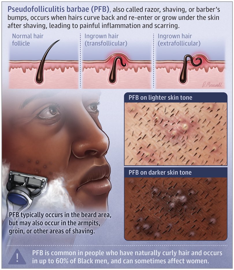 JAMANetwork's tweet photo. Last but not least,  @maxwell_visuals, student intern, won an Award of Merit for the @JAMADerm Patient Page,  Pseudofolliculitis Barbae. Visit the page here: https://t.co/RrQzIvTLXv https://t.co/yFIJrbdiqy
