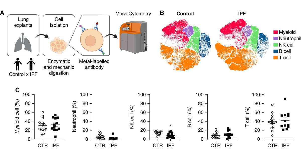 Multiplatform Single-Cell Analysis Identifies Immune Cell Types Enhanced in Pulmonary Fibrosis

🔗 bit.ly/3amqWrT