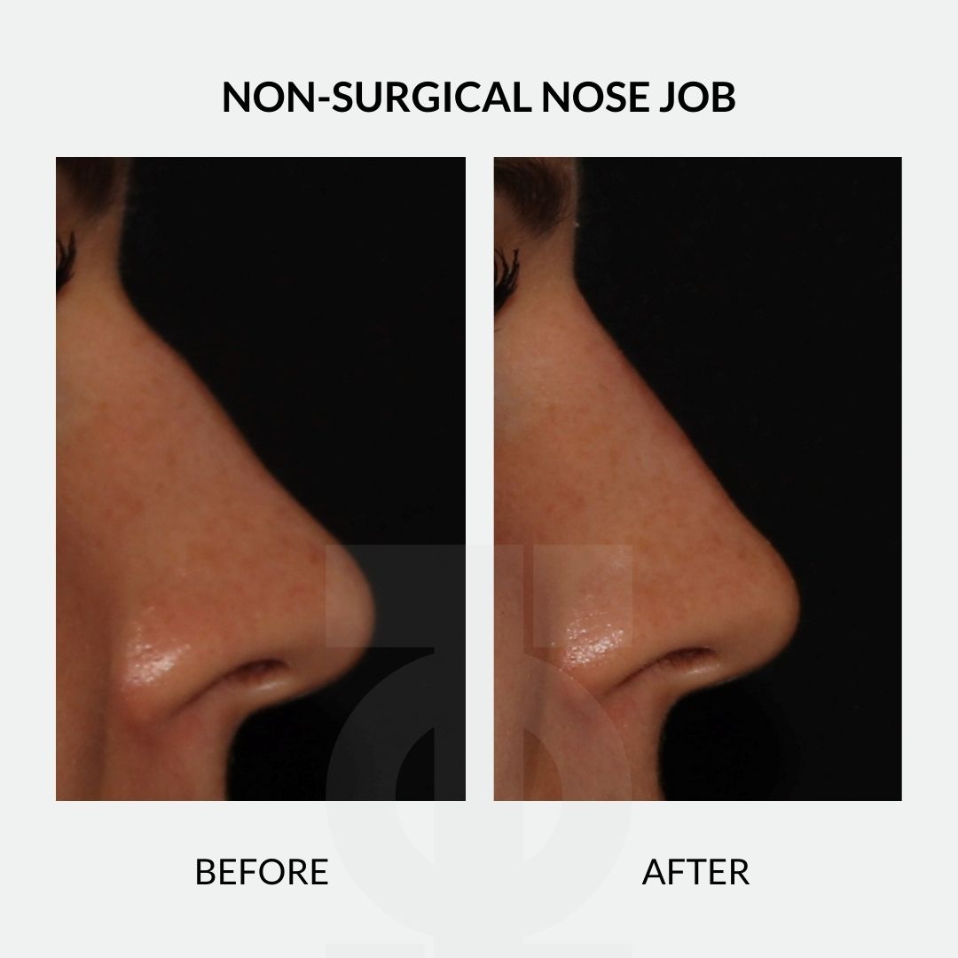 ⁣
Incredible result using dermal fillers to treat a dorsal hump. ⁣👃
⁣