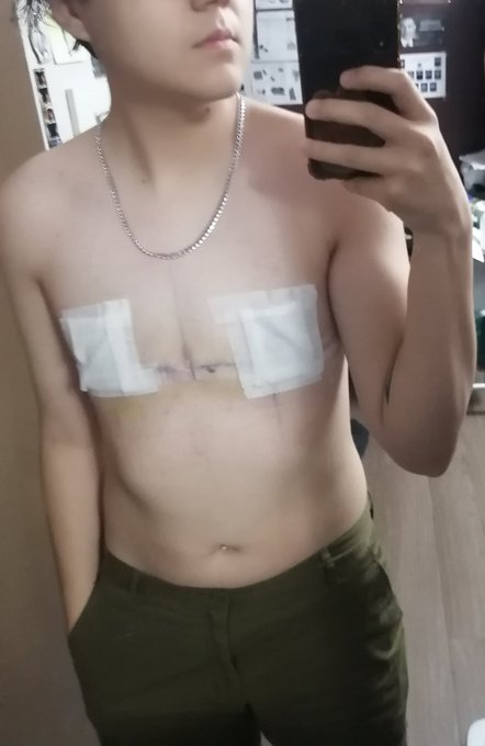 Just got out of the first shower I have been able to take since the surgery and i feel fantastic! Here<a href="/tag/trans"class="tags"><span>#trans</span></a><a href="/tag/topsurgery"class="tags"><span>#topsurgery</span></a>