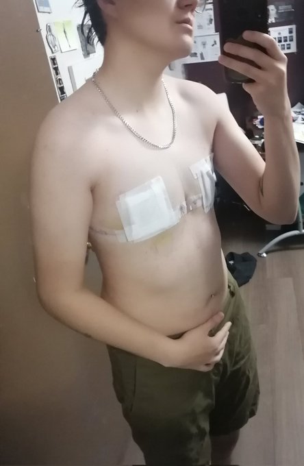 Just got out of the first shower I have been able to take since the surgery and i feel fantastic! Here<a href="/tag/trans"class="tags"><span>#trans</span></a><a href="/tag/topsurgery"class="tags"><span>#topsurgery</span></a>