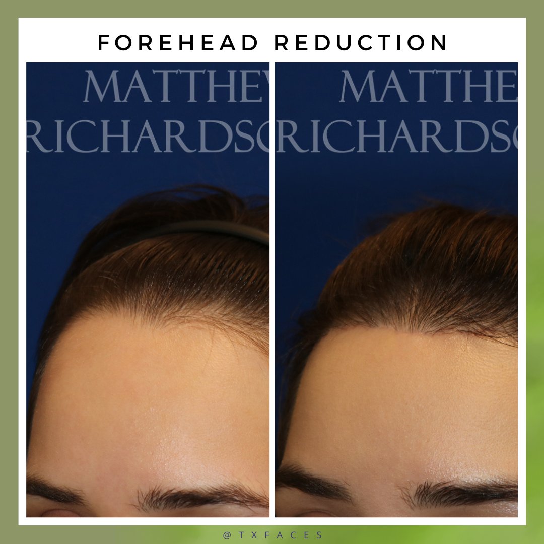 txfaces's tweet photo. This patient who a #foreheadreduction surgery. Photos are 4 months post-op and you can see it is all healing beautifully!
Procedure by Matthew Richardson, MD https://t.co/7CUh74ILWY