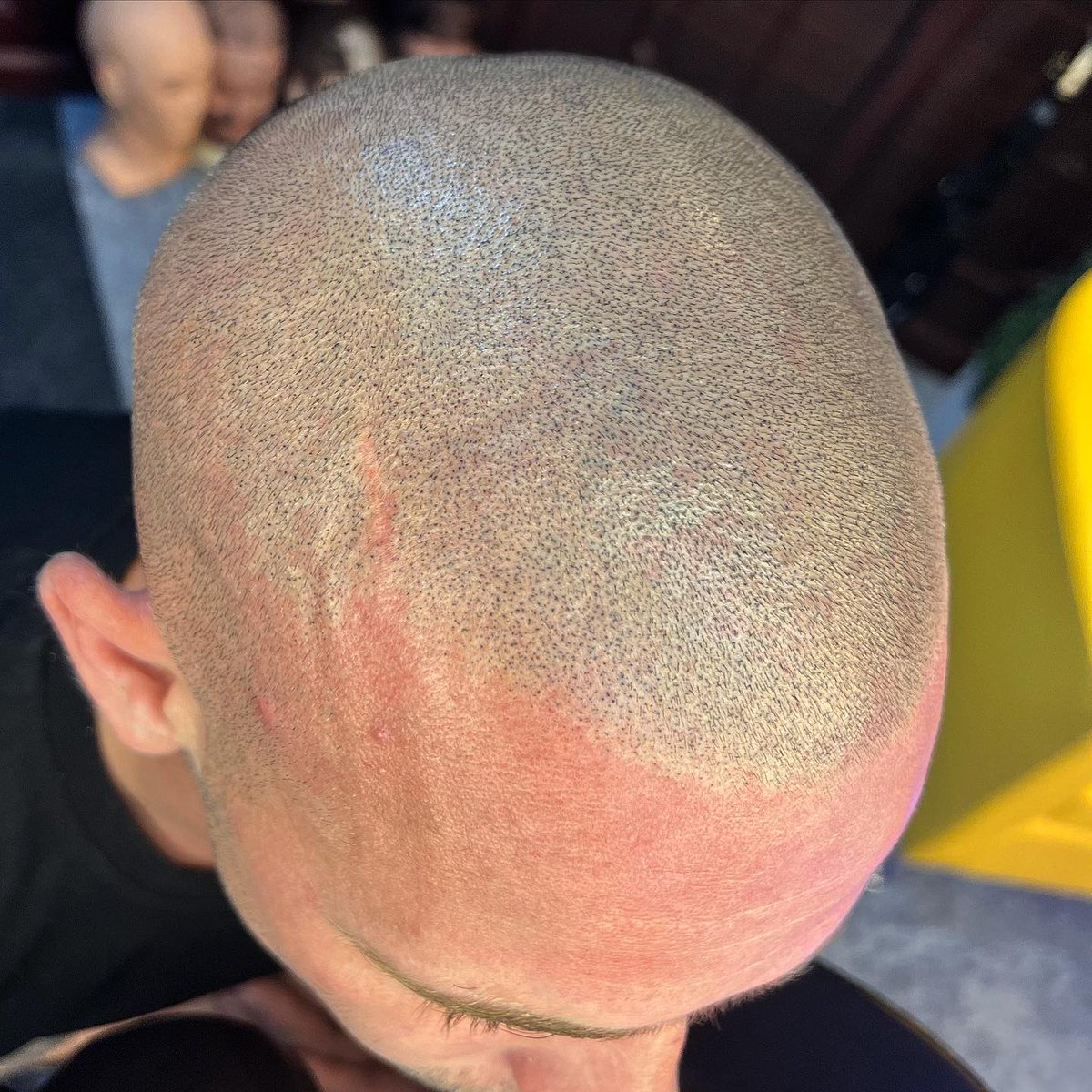 scalprenovation's tweet image. ⚡️👨🏼‍🦲⚡️

Second session on our first model ⬆️ 

💉Needles - @icconsmp 

🖊 Ink - @folicule 

#SMP
#SCALPMICROPIGMENTATION
#SCALPPIGMENTATION
#SCLAPRENOVATION
#UKBARBER
#MENSHAIR
#HAIRLOSS
#HAIRLOSSTREATMENT 
#MALEPATTERNBALDNESS
#ALOPECIA 
#HAIRTATTOO
#HAIRLOSSTATTOO