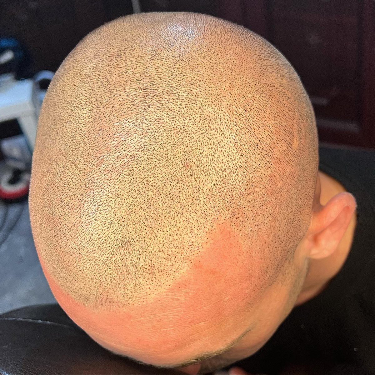 scalprenovation's tweet image. ⚡️👨🏼‍🦲⚡️

Second session on our first model ⬆️ 

💉Needles - @icconsmp 

🖊 Ink - @folicule 

#SMP
#SCALPMICROPIGMENTATION
#SCALPPIGMENTATION
#SCLAPRENOVATION
#UKBARBER
#MENSHAIR
#HAIRLOSS
#HAIRLOSSTREATMENT 
#MALEPATTERNBALDNESS
#ALOPECIA 
#HAIRTATTOO
#HAIRLOSSTATTOO