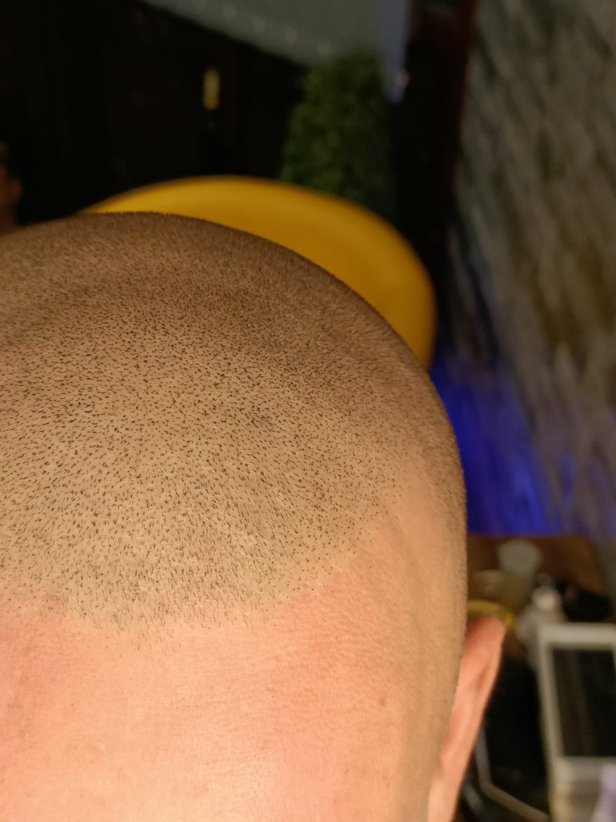 scalprenovation's tweet image. ⚡️👨🏼‍🦲⚡️

Second session on our first model ⬆️ 

💉Needles - @icconsmp 

🖊 Ink - @folicule 

#SMP
#SCALPMICROPIGMENTATION
#SCALPPIGMENTATION
#SCLAPRENOVATION
#UKBARBER
#MENSHAIR
#HAIRLOSS
#HAIRLOSSTREATMENT 
#MALEPATTERNBALDNESS
#ALOPECIA 
#HAIRTATTOO
#HAIRLOSSTATTOO