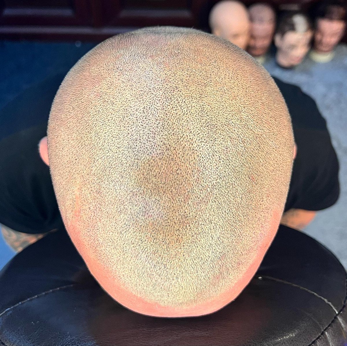scalprenovation's tweet image. ⚡️👨🏼‍🦲⚡️

Second session on our first model ⬆️ 

💉Needles - @icconsmp 

🖊 Ink - @folicule 

#SMP
#SCALPMICROPIGMENTATION
#SCALPPIGMENTATION
#SCLAPRENOVATION
#UKBARBER
#MENSHAIR
#HAIRLOSS
#HAIRLOSSTREATMENT 
#MALEPATTERNBALDNESS
#ALOPECIA 
#HAIRTATTOO
#HAIRLOSSTATTOO