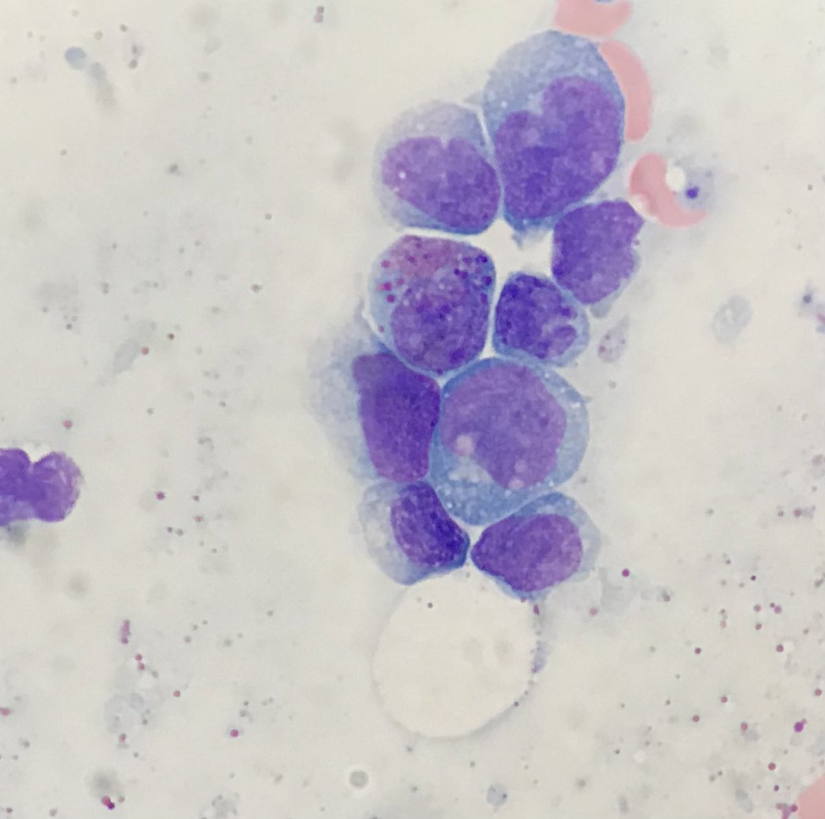 MoAli_Path's tweet photo. I am thinking of a translocation. Don’t just look at the blasts in an acute leukemia. AML with inv 16 or t(16;16). #hemepath #PathTwitter #pathfun https://t.co/uHlZkojQOx
