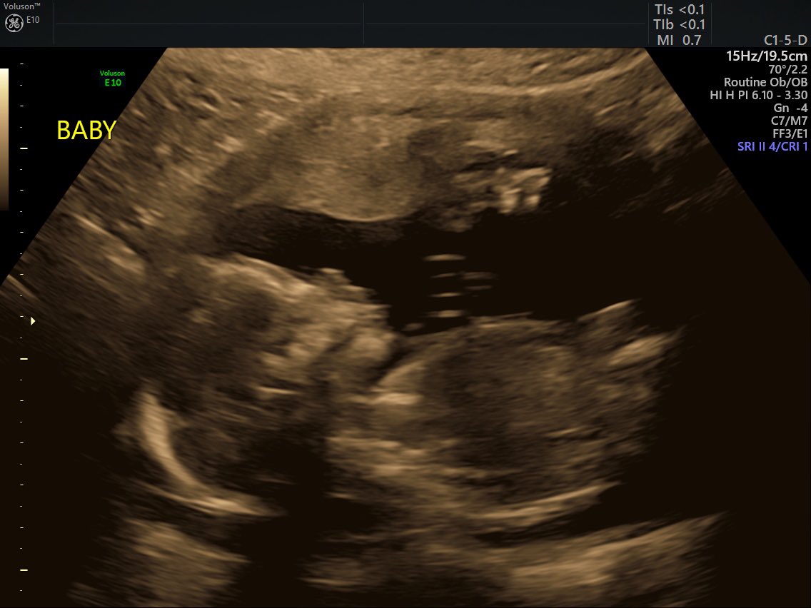 Renee_jaaay's tweet photo. I have my second anatomy scan for this little girl tomorrow. 🎀 please don’t be stubborn 😑 https://t.co/l3ywRtYwXN