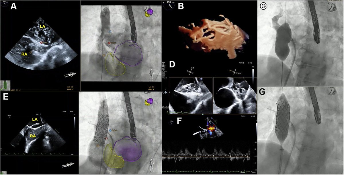 Tiffany Chen (@tiffchenmd) on Twitter photo Sinus venosus ASD closure w/ #yesCCT & #echofirst fusion guidance now out in #JACCINT <a href="/JACCJournals/">JACC Journals</a>! Multimodality #cvImaging tells the "hole" 🕳️ story
bit.ly/closeSVD
<a href="/rimhalabymd/">Rim Halaby</a> <a href="/mkvidula/">Mahesh Vidula, MD</a> <a href="/howard_herrmann/">Howard Herrmann</a> <a href="/PennCardiology/">Penn Cardiology</a> <a href="/HeartCare4Kids/">CHOPCardiacCenter</a> <a href="/ASE360/">American Society of Echocardiography</a> <a href="/Heart_SCCT/">Heart_SCCT</a> <a href="/crfheart/">Cardiovascular Research Foundation</a> Sinus venosus ASD closure w/ #yesCCT & #echofirst fusion guidance now out in #JACCINT <a href="/JACCJournals/">JACC Journals</a>! Multimodality #cvImaging tells the "hole" 🕳️ story
bit.ly/closeSVD
<a href="/rimhalabymd/">Rim Halaby</a> <a href="/mkvidula/">Mahesh Vidula, MD</a> <a href="/howard_herrmann/">Howard Herrmann</a> <a href="/PennCardiology/">Penn Cardiology</a> <a href="/HeartCare4Kids/">CHOPCardiacCenter</a> <a href="/ASE360/">American Society of Echocardiography</a> <a href="/Heart_SCCT/">Heart_SCCT</a> <a href="/crfheart/">Cardiovascular Research Foundation</a>