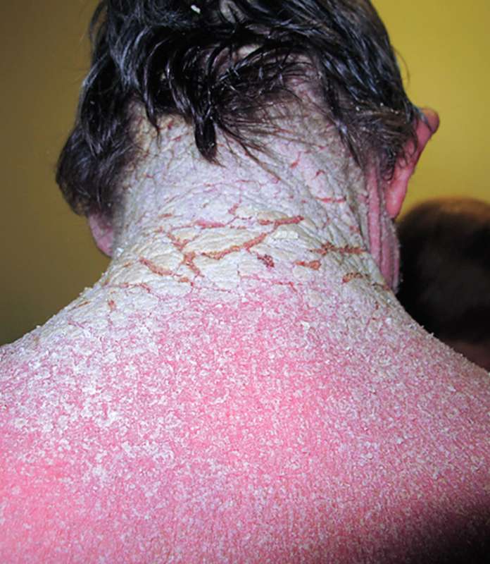 MoreXGrok's tweet photo. 71-year-old man with cirrhosis
♦️
severe diffuse pruritus
♦️
3 months 👉 with erythematous and scaly skin on the scalp hands
♦️
2 skin scrapings
no.👉mites
♦️
trt with oral, topical steroids https://t.co/mG450itqt1