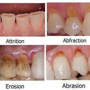 CuspDent's tweet photo. Don't wait for the pain. Get your dental check up done now @CuspDentalGwl https://t.co/DxjH4lo99L