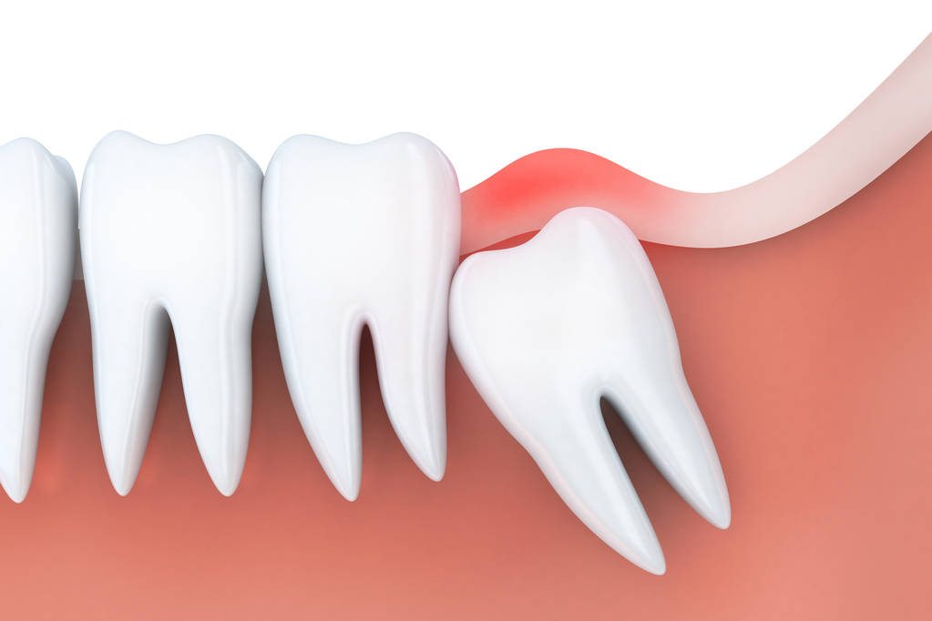 TSM_Trixtank's tweet photo. Don't let wisdom teeth removal stress you out - our Brisbane team is here to help! Call us today to book an appointment. Visit https://t.co/m7fO3zpp2U today! https://t.co/D1C1xgAMdK