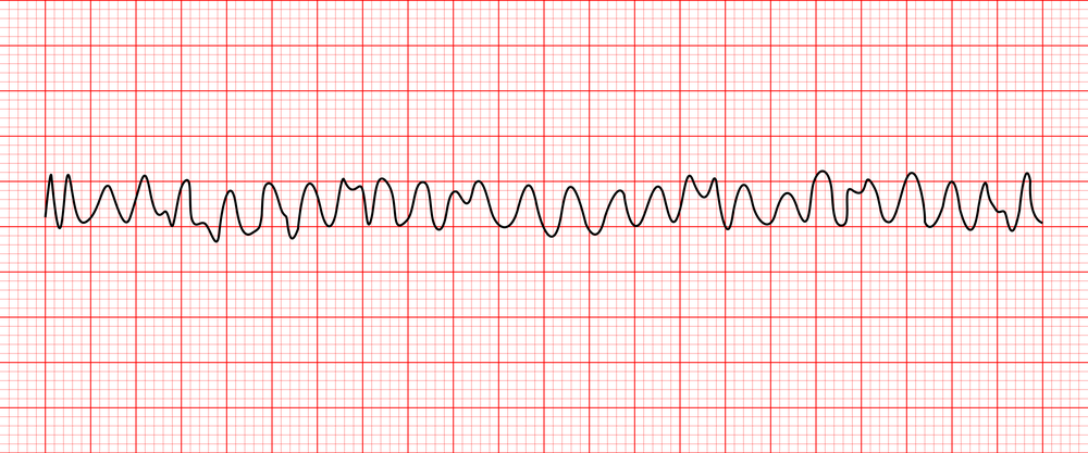 AliMedic_'s tweet photo. ايش تخطيط القلب هذا؟
كيف راح تتصرف؟
وش العلاجين اللي نستخدمهم في حاله الانعاش لهذا التخطيط؟ https://t.co/8r77G4hUma