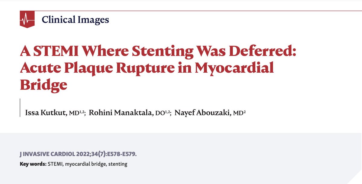 This set of clinical images demonstrates the importance of performing hemodynamic assessment of intermediate-appearing coronary lesions, as well as utilizing intracoronary imaging to characterize coronary lesions. okt.to/2pbI5s