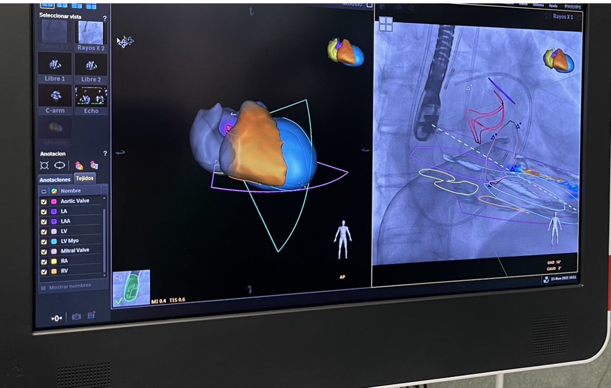 Se cumplen más de 2 años de nuestro Programa de Estructural. Unidad de Hemodinamica. Servicio de Cardiología. Hospital Universitario Lucus Augusti. Lugo. Enhorabuena a todo el equipo!!!!! <a href="/carlosjuanatey/">carlosjuanatey</a> <a href="/CardiologiaHULA/">Cardiología HULA</a> <a href="/secardiologia/">Soc Esp Cardiología</a> <a href="/SOGACAR_/">SOGACAR Cardiología</a> #somosHULA #SERGAS <a href="/Xunta/">Xunta de Galicia</a> #lugo