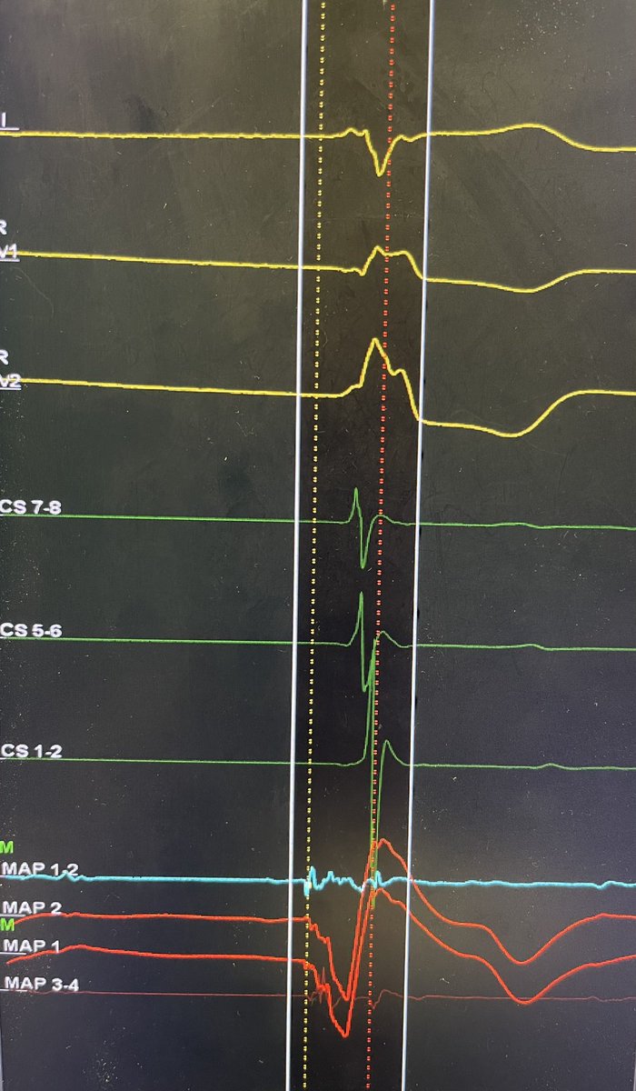 Ablation of frequent symptomatic PVCs via transeptal approach, SOO inferior septal mitral annulus, in a patient with occluded infra renal aorta s/p bypass. #cardiotwitter #EPeeps @drpaari @syamkumarmd @drsuneet @MRazminia @drSurf22 @CyrusHadadiMD @J_CostelloDO @DrRoderickTung