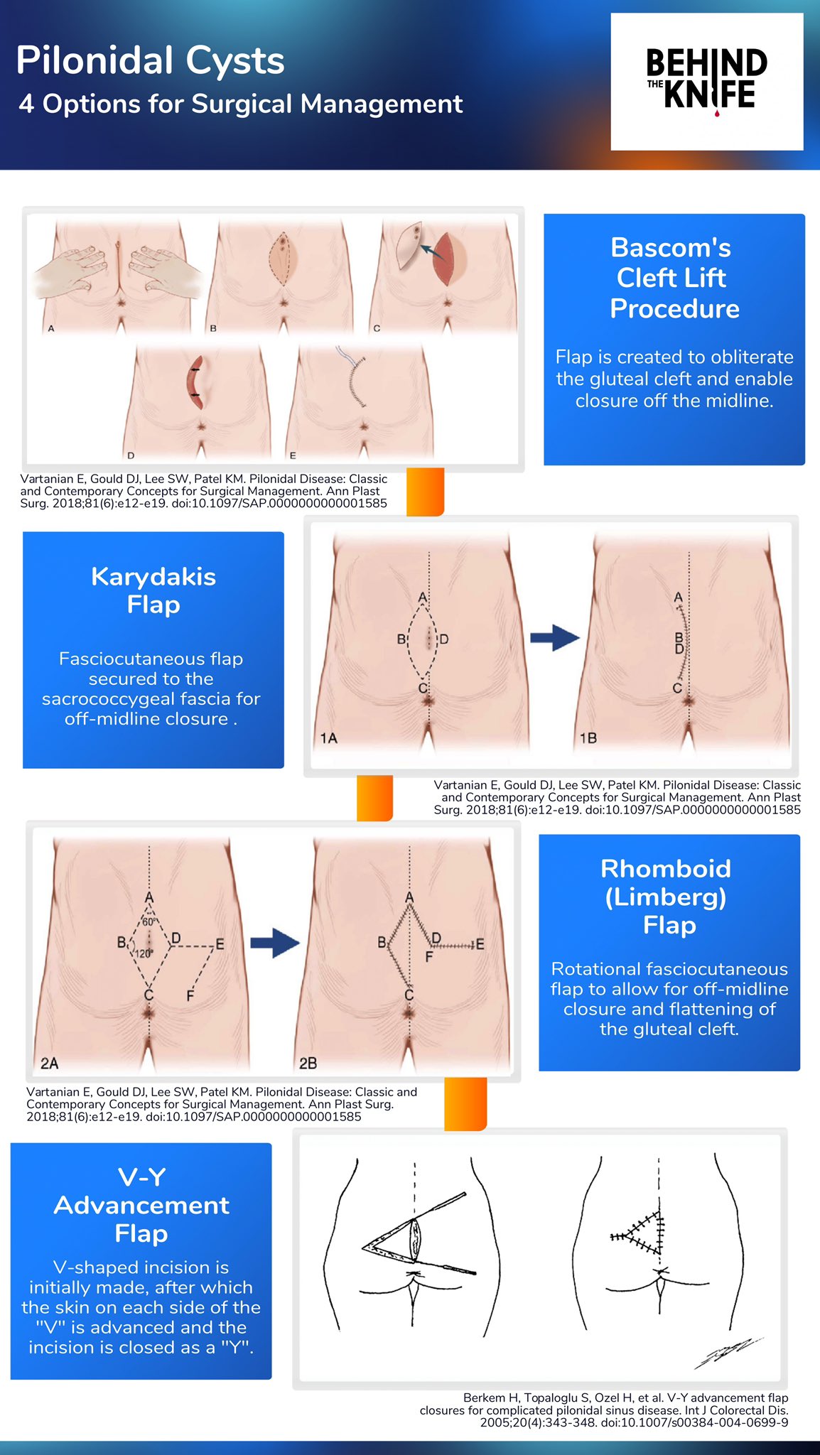 BehindTheKnife on X: Pilonidal Cysts - mundane complaint or sneaky nuanced  problem? Catch @ScottRSteeleMD, @georgoff, and @ShanazHossainMD as they  discuss the management of pilonidal cysts in our latest episode! Use this  handy