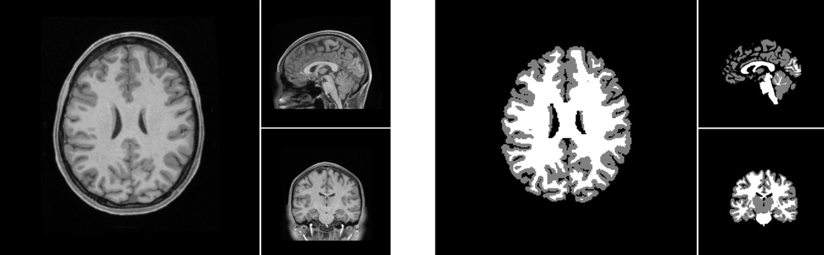 🧠 Learn about "Brain Chop," a web-based end-to-end solution which performs 3D MRI brain segmentation that's #madeWithTFJS. 

This tool is known for its simplicity, privacy preservation, and user-friendly interface. ➡️ goo.gle/3Jbabx0