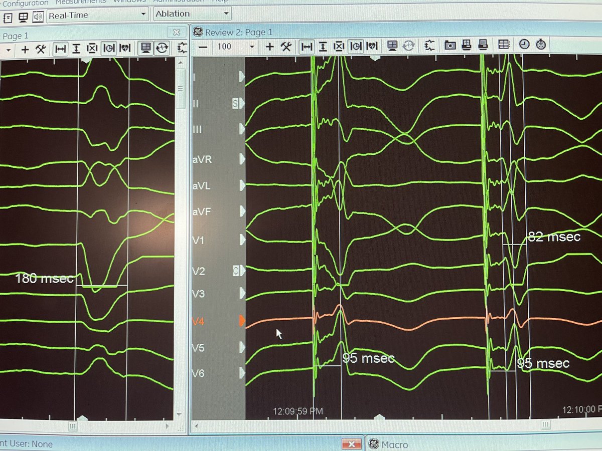 Pre and post his pacing. Prior cs lead w ugly rbb morphology and qrs@duration of 170. Resting lbbb 180 msec. You can see non selective followed by selective w same lvat indicting his capture. Just love this stuff! #epeeps