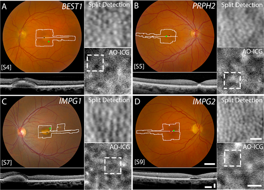 ARVOiovs's tweet photo. Article published today by Johnny Tam et al. @NatEyeInstitute uses multimodal adaptive optics imaging to show that retinal lesions from vitelliform macular dystrophy (VMD) vary by gene mutation. @ARVOinfo
https://t.co/BMP6F9sJaF
See more on NEI news site https://t.co/91j3Q7dnkd https://t.co/4STz5xmgP5