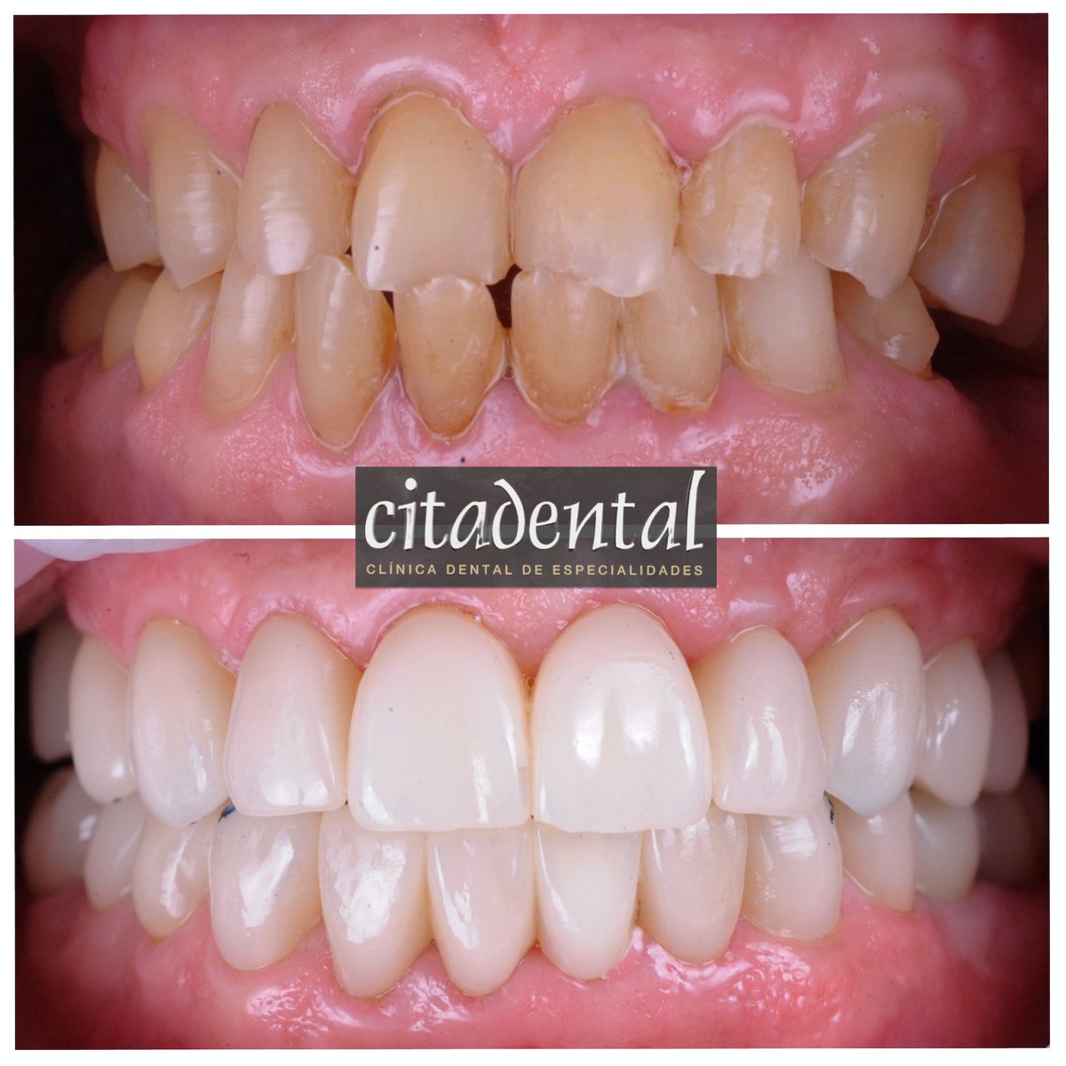 Citadental's tweet photo. Hoy les dejamos con un caso de diseño de sonrisa, en que se ha hecho una subida de dimensión vertical mediante carillas, implantes y coronas, del Dr Eloy Barrera. Caso de diseño de sonrisa digital que implica un cambio radical en la funcionalidad y estética para el paciente! https://t.co/qOCabuBOXa