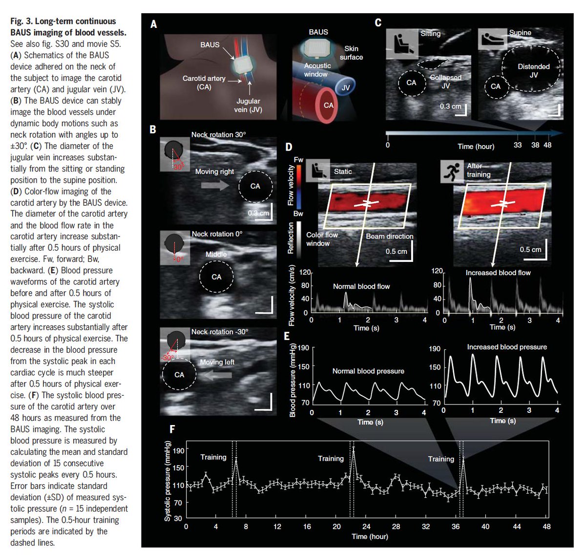 Wow. A wearable ultrasound patch for continuous, on the go, high-quality imaging of most parts the human body. A remarkable new innovation with diverse clinical applications @ScienceMagazine science.org/doi/10.1126/sc… @ProfZhaoMIT @ChongheWang @MIT @MITMechE