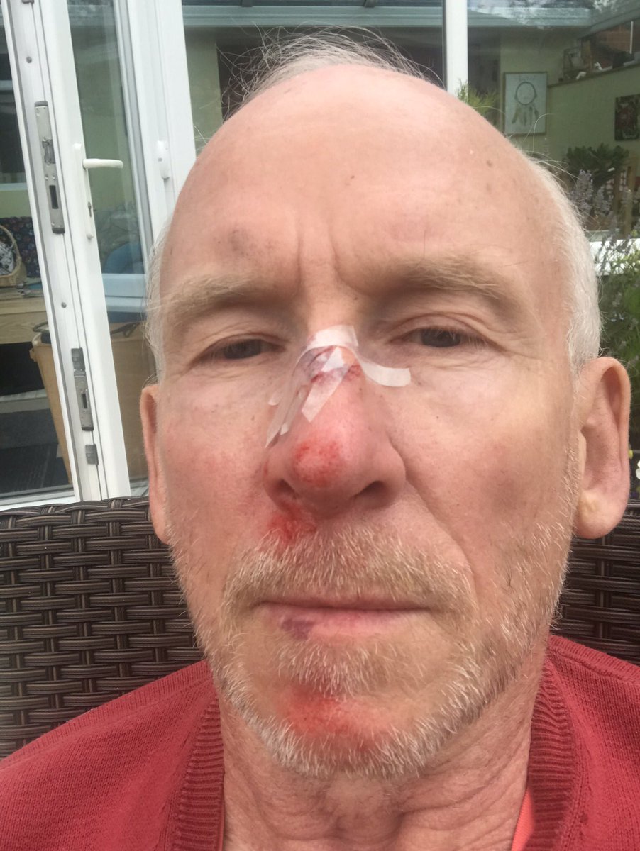 Why didn’t I go to A&amp;E after a fall? I couldn’t face a long wait to get stitches in my nose, after hearing all the media reports of lengthy waiting times. Fortunately my wife gave me First Aid. Is this the future of the NHS for minor injuries - DIY - or have I missed something?