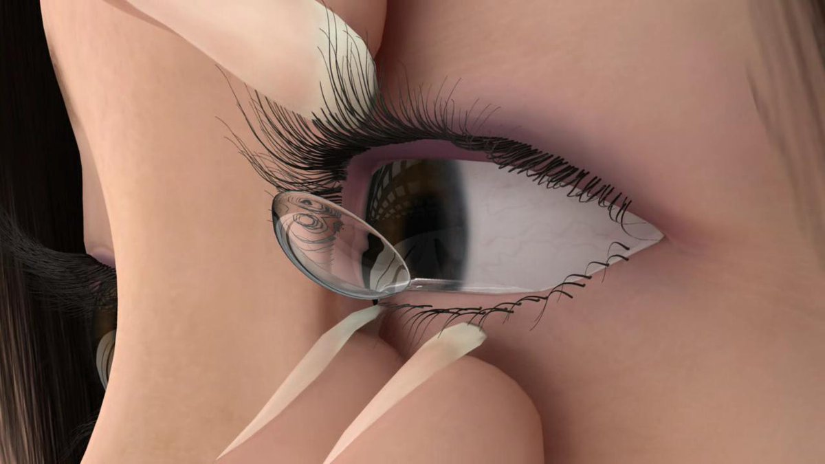 RayLewis_Opt's tweet image. ow.ly/HRGP103QWVJ ow.ly/AzPi103RcLi Latest developments in keratoconus to be explored at KeraClub 2022 - Insight