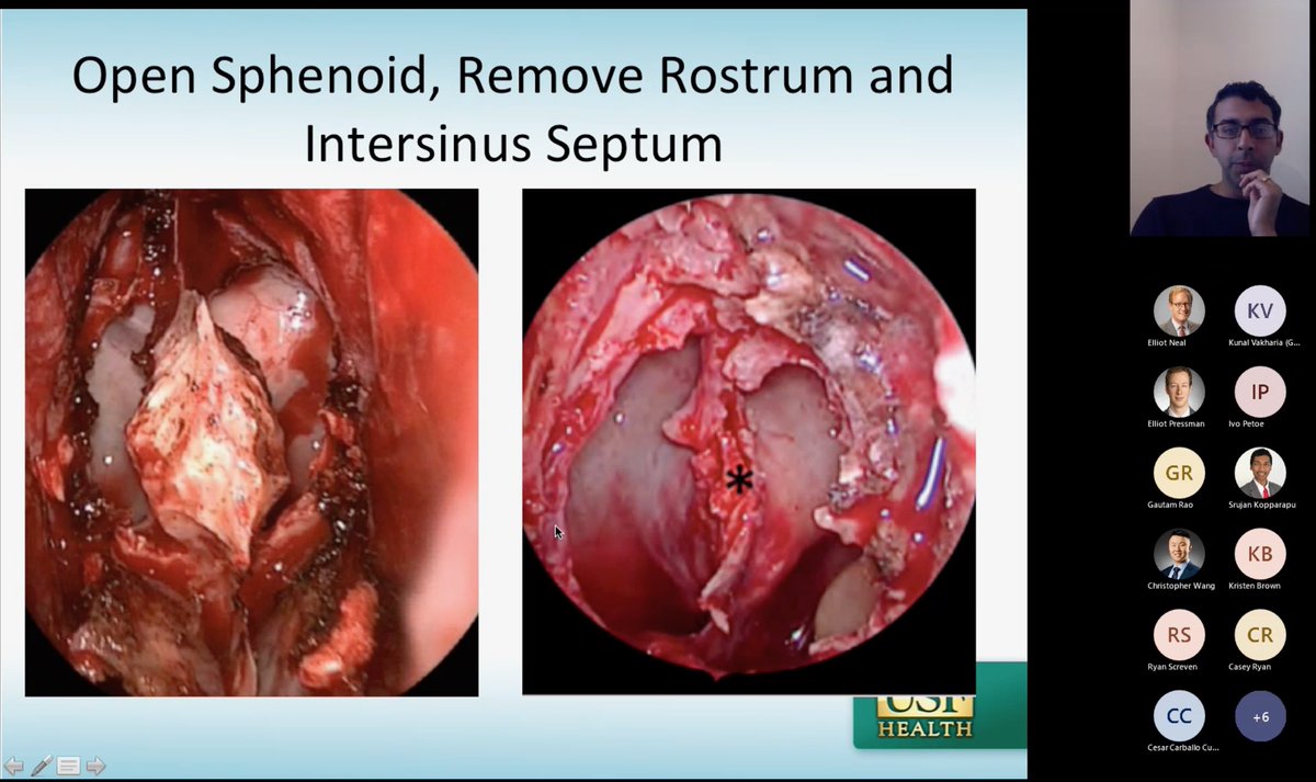 Kicking off our annual #skullbase course for <a href="/USFNeurosurgery/">University of South Florida Neurosurgery</a> #residents with a talk about #endoscopic approaches to the #sella with #ArjunParasher from #USF #ENT 
#neurotwitter #MedTwitter #otorhinolaryngology
