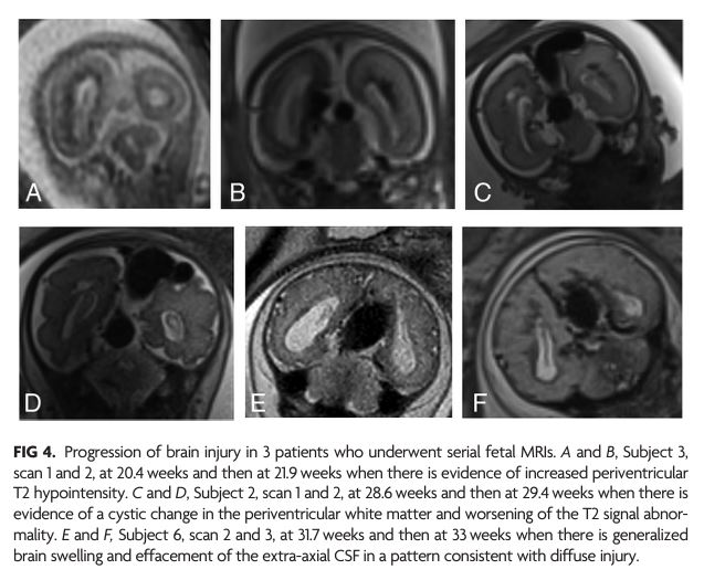 AJNR (@theajnr) on Twitter photo "Brain Injury in Fetuses with Vein of Galen Malformation and Nongalenic Arteriovenous Fistulas: Static Snapshot or a Portent of More?" #OpenAccess #EditorsChoice #AVF <a href="/The_ASPNR/">American Society of Pediatric Neuroradiology</a> <a href="/Camilojaimesc/">Camilo Jaimes</a> | bit.ly/3PVcyGw "Brain Injury in Fetuses with Vein of Galen Malformation and Nongalenic Arteriovenous Fistulas: Static Snapshot or a Portent of More?" #OpenAccess #EditorsChoice #AVF <a href="/The_ASPNR/">American Society of Pediatric Neuroradiology</a> <a href="/Camilojaimesc/">Camilo Jaimes</a> | bit.ly/3PVcyGw