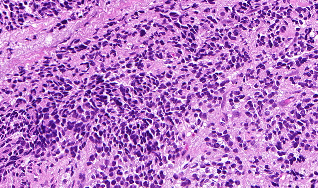 Ethmoid sinus, adult

#ENTpath #Dermpath #BSTpath #Pathresidents #PathTwitter