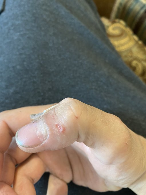 Doesn&rsquo;t look like much now but I assure you..it&rsquo;s a deep one. Was bleeding like a motherfucker when it