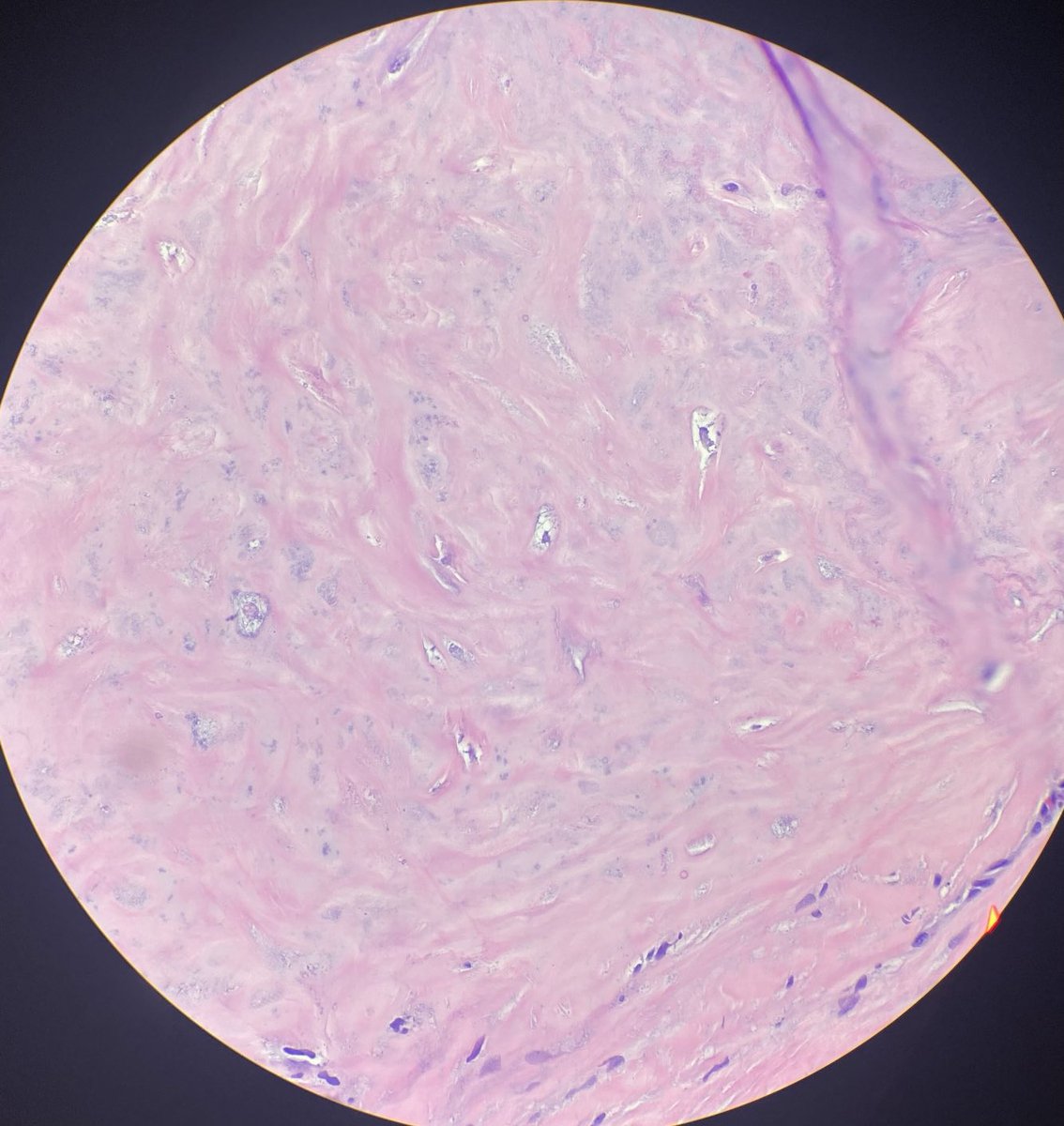 Pleomorphic adenoma of the breast.
AKA benign mixed tumor. Rare tumor. Admixture of luminal epithelial and myoepithelial cells embedded in chondromyxoid /mucinous stroma. True osteoid changes may occur. Myoep cells are usually polygonal and singly throughout the stromal matrix.