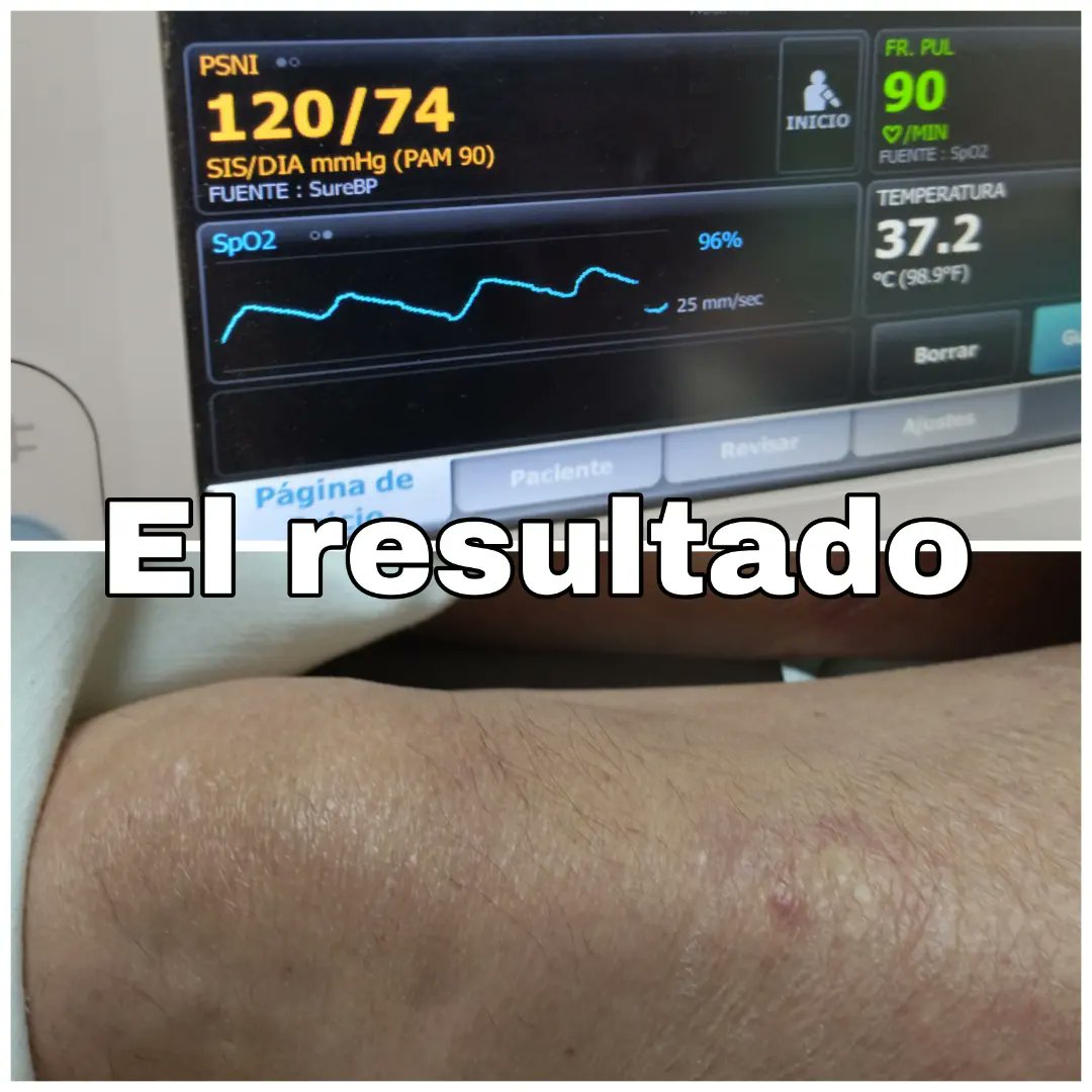 Dr_Dive's tweet photo. 👴🏼DM, vive solo. Hallado con deficit neurológico, disnea.
Evaluación y toma de decisiones con recursos no invasivos y sin laboratorios, dirigimos manejo.
@PabloAl70895951 #Rotacion #VenueGo @jorgepocus @generalelectric #Plets #TFc #ECG
@DraSolisM https://t.co/hqMCsv7LUz