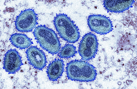 bmj_latest's tweet photo. NEW research published by The BMJ today identifies important differences in monkeypox symptoms between the current outbreak and previous outbreaks in endemic regions https://t.co/uYnhbZoBhd https://t.co/NZNoNVi6Lm