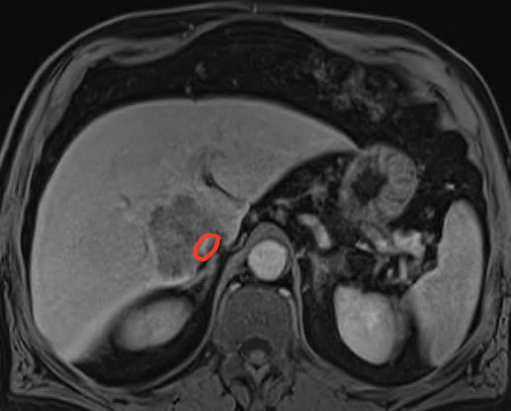 🤔what to do with this IVC encasing CRLM 60a synchron asymptomatic mCRC Pat?🤨