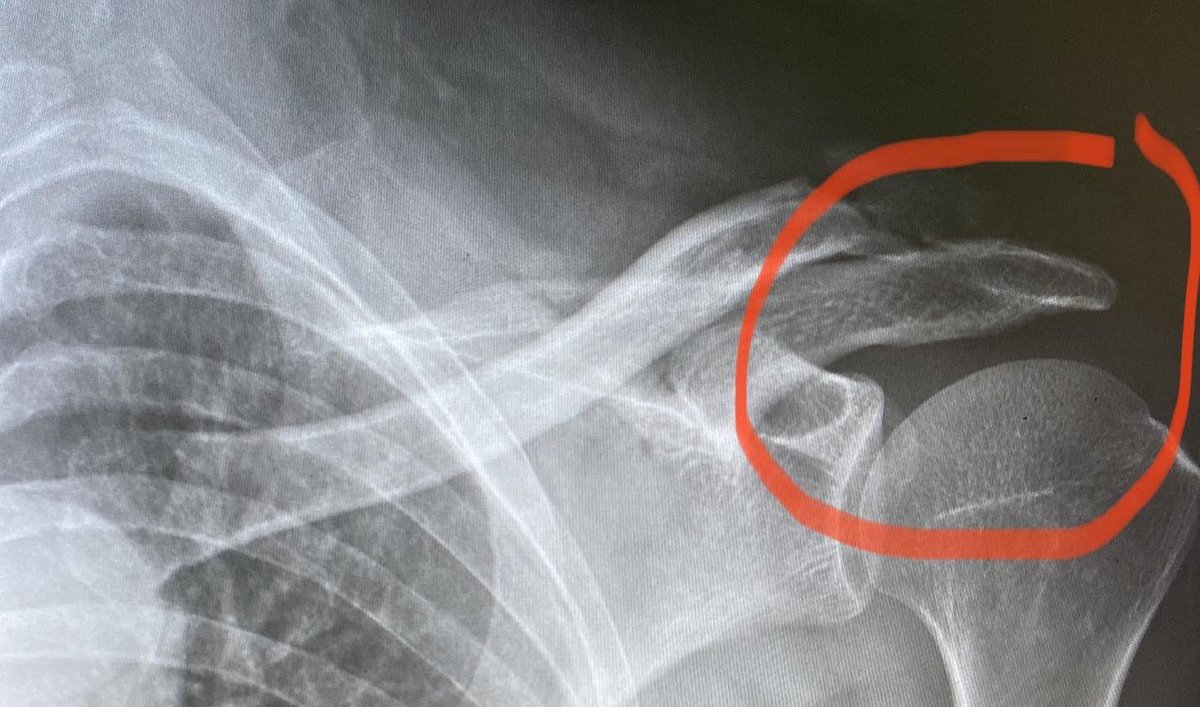 marcus_peron's tweet photo. While riding to the #cyclehighpark demonstration late yesterday afternoon, I got “doored” by a SUV at Bloor &amp; Royal York. Managed to bike home but with broken clavicle now, that’s it for riding for the next 6 weeks. #cycling #roadcycling #gettingdooredsucks #gettingdooredhurts https://t.co/XwQl8nVEco