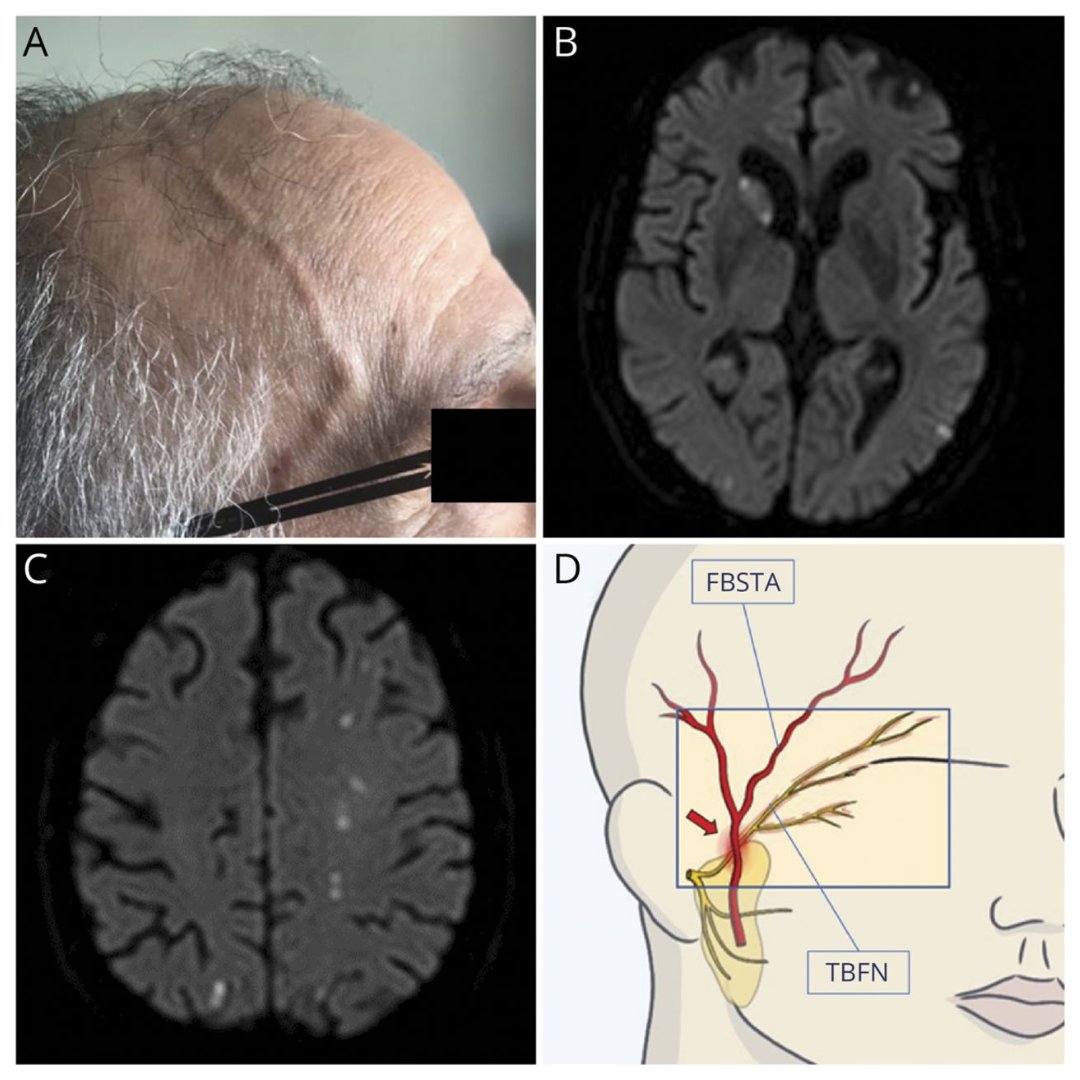 Teaching Video #NeuroImage: Bilateral Hemifacial Spasm in Giant Cell Arteritis bit.ly/3SHyPcQ #NeurologyRF #NeuroTwitter