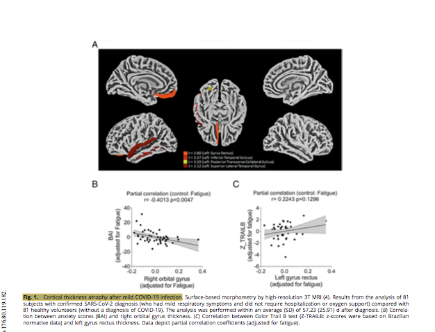 gorka_orive's tweet photo. Un estudio preliminar sugiere que el SARSCoV2 llegaría al cerebro, infectaría los astrocitos, pudiendo promover la muerte neuronal. Aportan un estudio con autopsias a 26 fallecidos por COVID19, donde en 5 detectaron el virus en astrocitos. Ver con cautela. https://t.co/Ibz3m6VSKn https://t.co/Ci7rAfuA8H