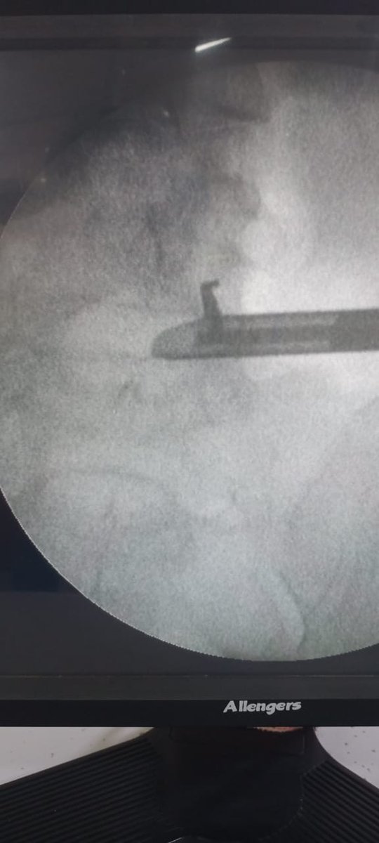 deathdealerdoc's tweet photo. It is a proud feeling when you do a challenging case refused at other centres and do it using #PELD under local anesthesia. Was a great sight to watch as my student of this month Dr. Sharadendu Narayan from Jamshedpur did a wonderful #PELD for large extruded disc. https://t.co/3YzuMzdlED