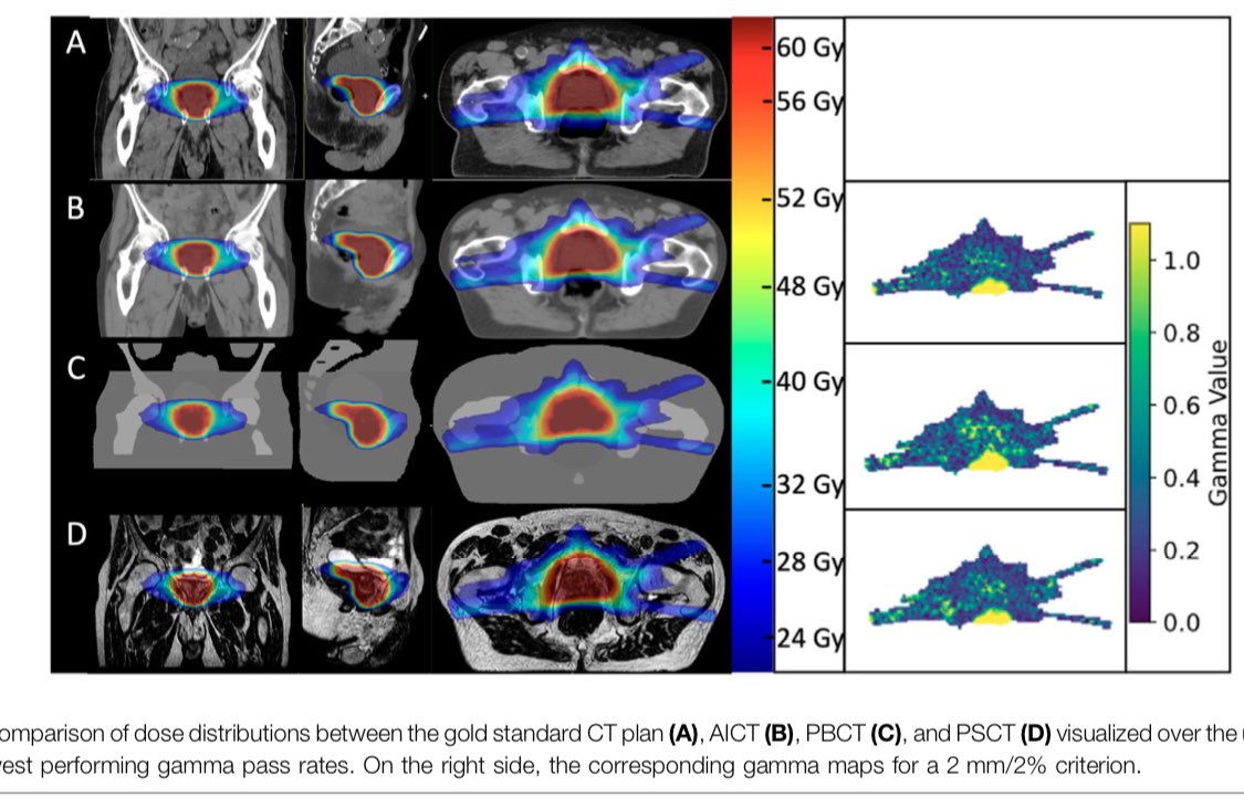 Towards AI based MR only radiotherapy treatment planning. More great work from the MR-Linac research team in Tübingen. #radonc <a href="/MarcelNachbar/">Marcel Nachbar</a> @D_Thorwarth <a href="/d_zips/">DZips</a> 

doi.org/10.3389/fphy.2…